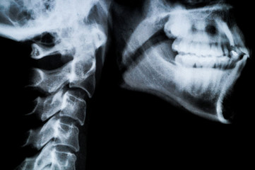 X ray neck and Jaw