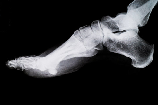 X Ray of the Foot.