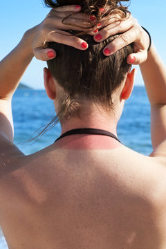 Young woman showing neck sunburn on the beach in summer