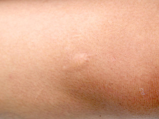 scar on the skin. macro