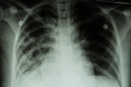 Pulmonary Tuberculosis ( TB )  :  Chest x-ray 