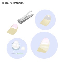 Fungal Nail Infection and Take Care