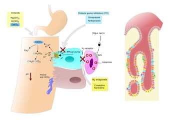 azione degli antiacidi in caso di ulcera o gastrite