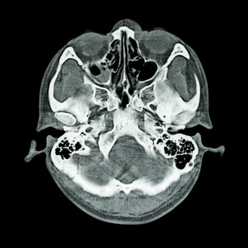 CT scan of brain and base of skull