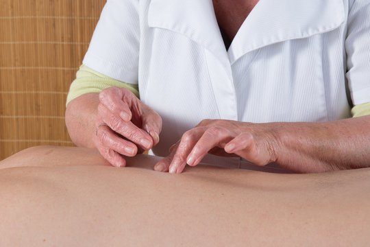 Acupuncturist prepares to tap needle into patients skin