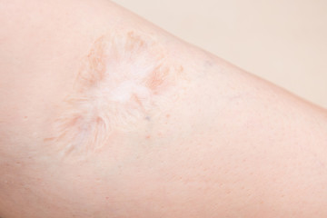 Fototapeta premium scars on leg wound from missile