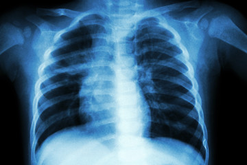 Pulmonary Tuberculosis ( Chest X-ray of child )