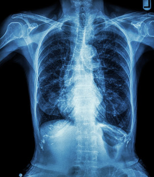 Chest X-ray of old patient ( calcification at rib , trachea )