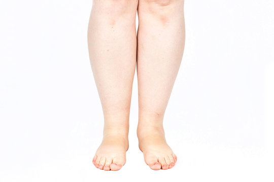 legs obese. Weight problems. trouble walking. płaskosotopie, valgus knee