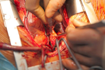 Open-heart surgery coronary artery bypass grafting