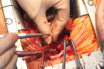 Coronary bypass surgery work detail closeup