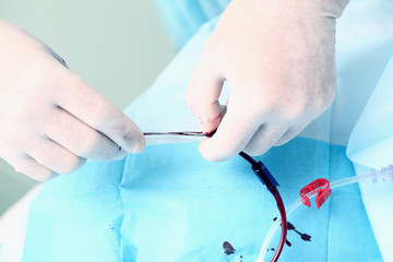 Blood catheter fixed by doctor