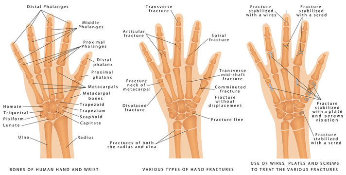 Various types of hand fractures