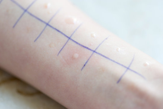 Close up of marking on allergic woman's hand