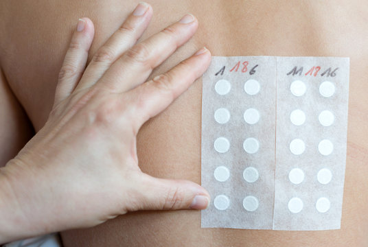 Germany, Person undergoing allergy test