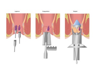 principali tecniche chirurgiche per emorroidi