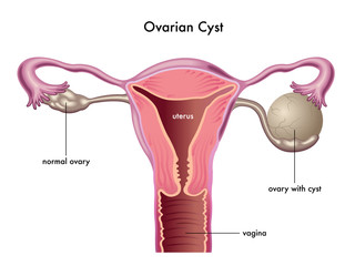 cisti ovarica