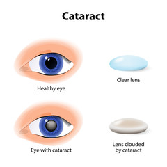 A cataract is an clouding crystalline lens - obrazy, fototapety, plakaty