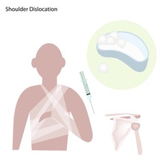 Recurrent Dislocation of Shoulder with Medical Treatment
