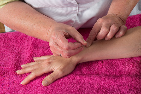 Detail of acupuncturist placing a needle in hand of the patient