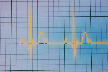 ECG / EKG monitor
