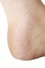 dry skin texture detail of human foot