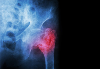 intertrochanteric fracture left femur ( Thigh bone )  - obrazy, fototapety, plakaty