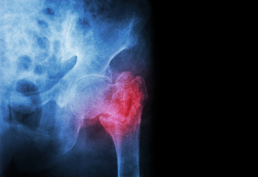 Intertrochanteric Fracture Left Femur ( Thigh Bone ) 