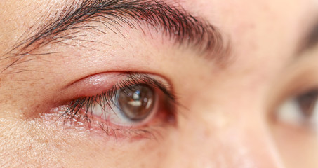 Right upper eye lid abscess "stye or hordeolum"