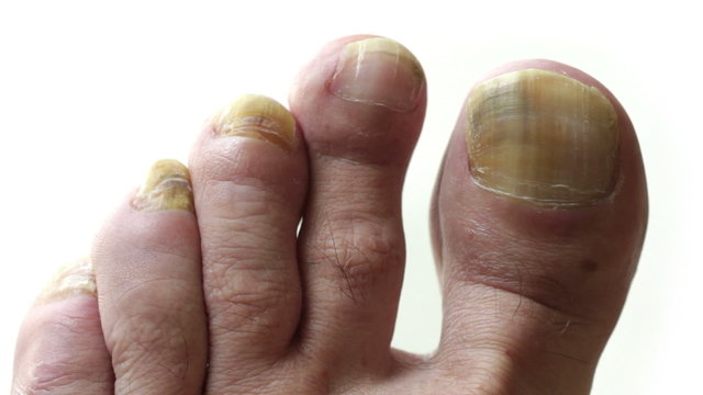 Fungi Toes