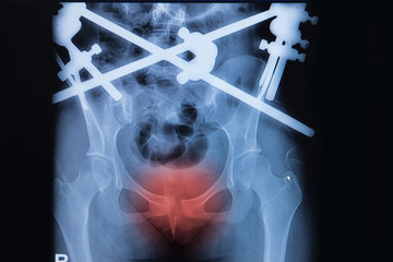 fracture pubic symphysis with external fixation