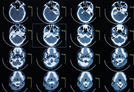 Series Of Images From A Computerized Tomography Of The Brain