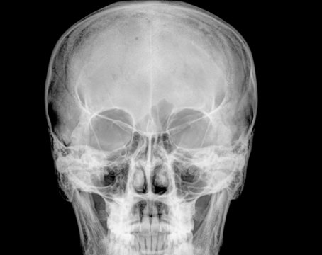 Front face skull in x-ray image