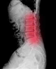 Scanning of a left lateral lumbar spine radiograph taken, among others radiographs, to try to detect the origin of pain in the hip of an adult man