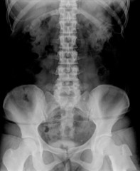 film X-ray show bilateral renal stone (round-shaped at right and left side)