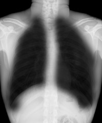 "Bronchiectasi s" X-ray chest show : multiple lung bleb and cyst due to chronic infection