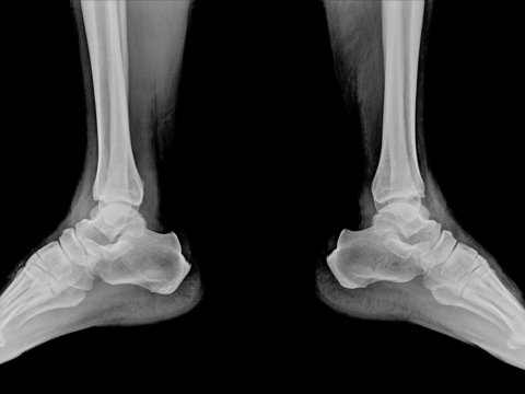 X-ray of 2 foot on black background