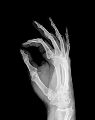 X-ray of both human hand (OK!)