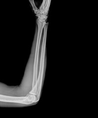 X-ray of elbow on a black background