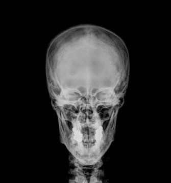 Film skull, antero-posterior view
