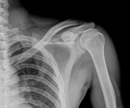 X-ray of human shoulder