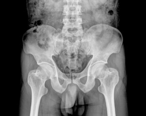 film x-ray human's pelvis and hip joints