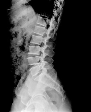 x ray of human lumbar spine lateral