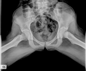 X ray film of pelvic bone