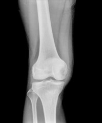 X-ray picture showing knee joints