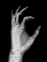 X-ray of both human hand (OK!)