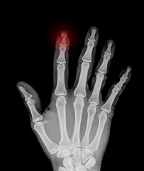 Obraz premium X-ray of hand fractures