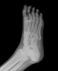 x-ray of foot on black background
