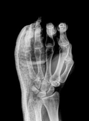 x ray hand with wear a cast