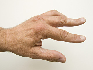 Hand Neurodermitis 584